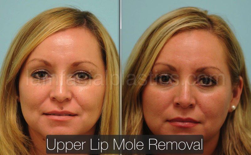 Facial mole removals