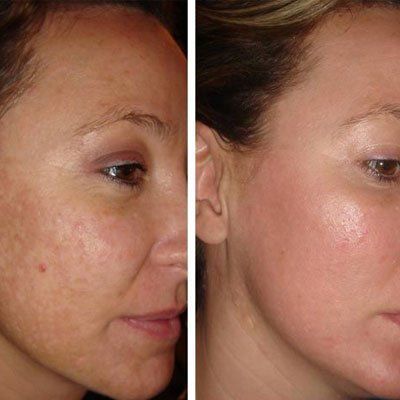 Leather reccomend Causes of melasma facial swelling