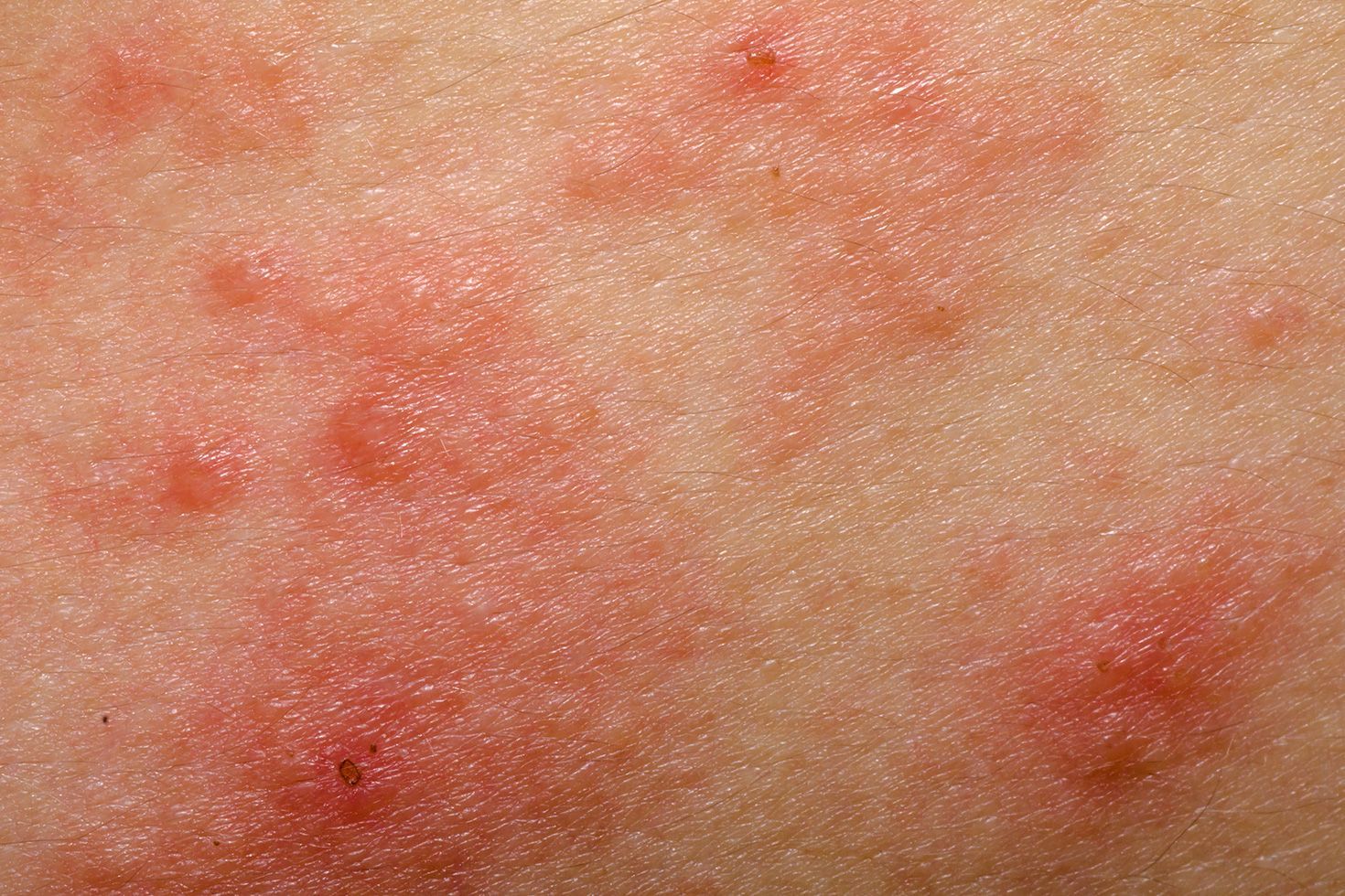 Itchy bleeding rash around anus
