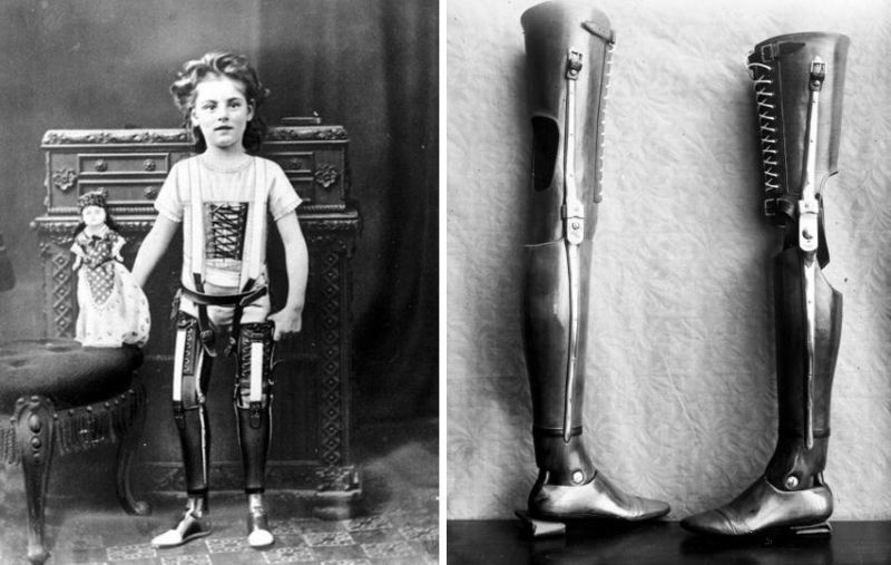 Sabertooth reccomend 1890 girl with artificial legs