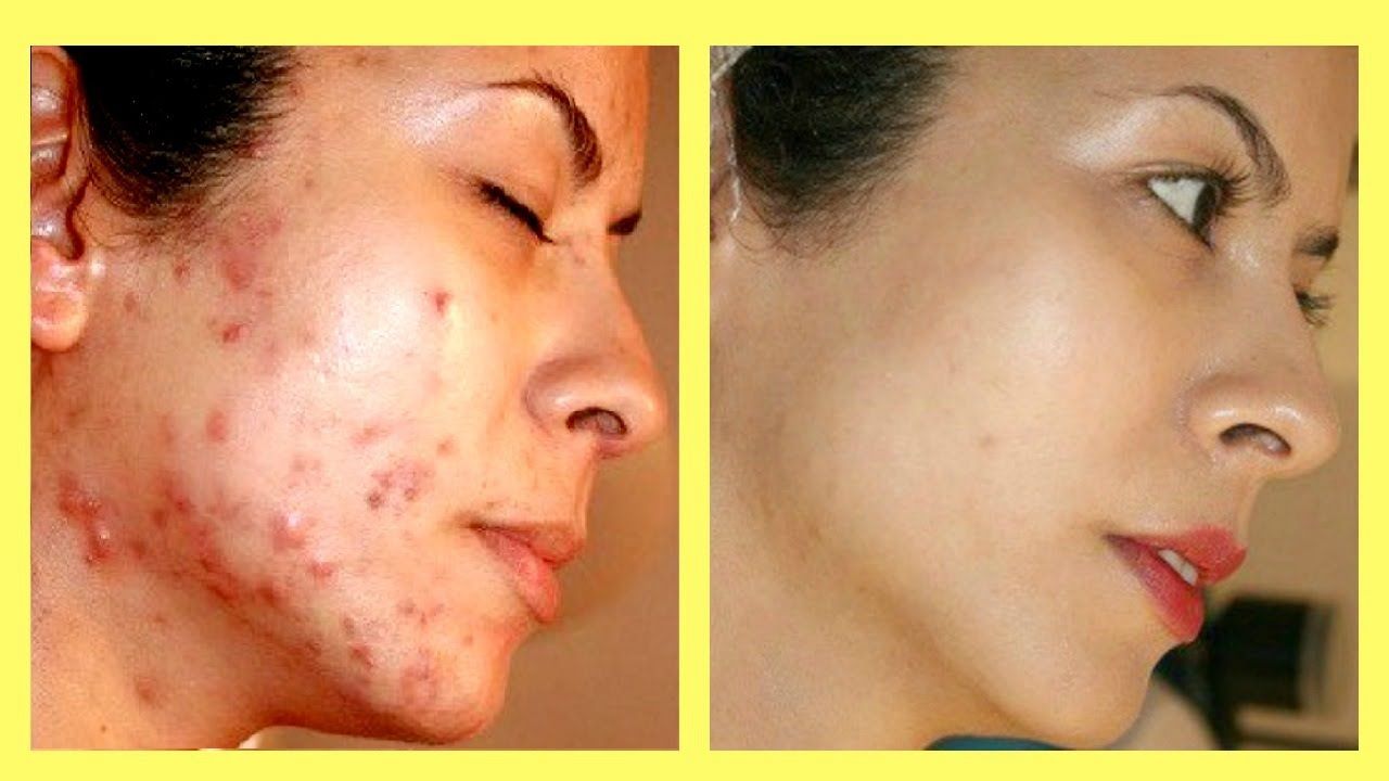 best of Facial Naturally acne clear