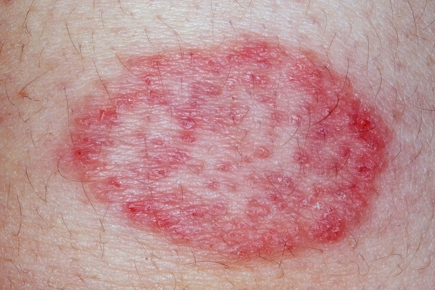 Bad M. F. reccomend Itchy bleeding rash around anus