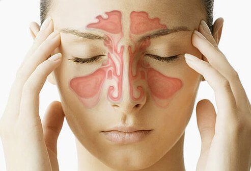 Sinus infection causing facial paralysis