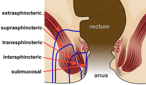 Curing anal blockage
