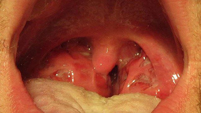 Foot-long reccomend Symptoms strep b infection adults