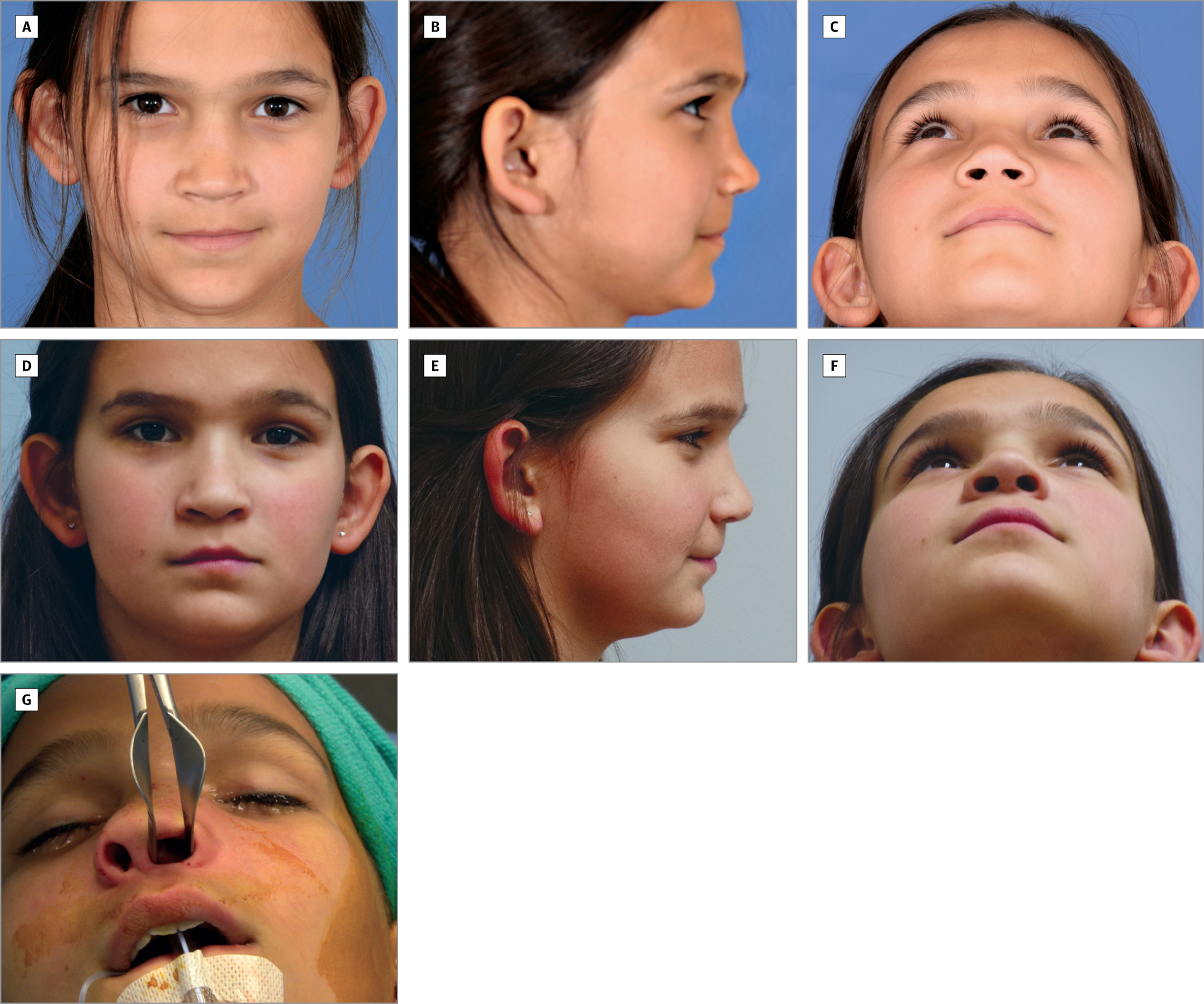 Bulldog reccomend Laboratory abnormalities after a facial fracture