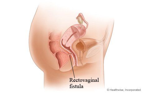 best of Rectal fistula of Sign