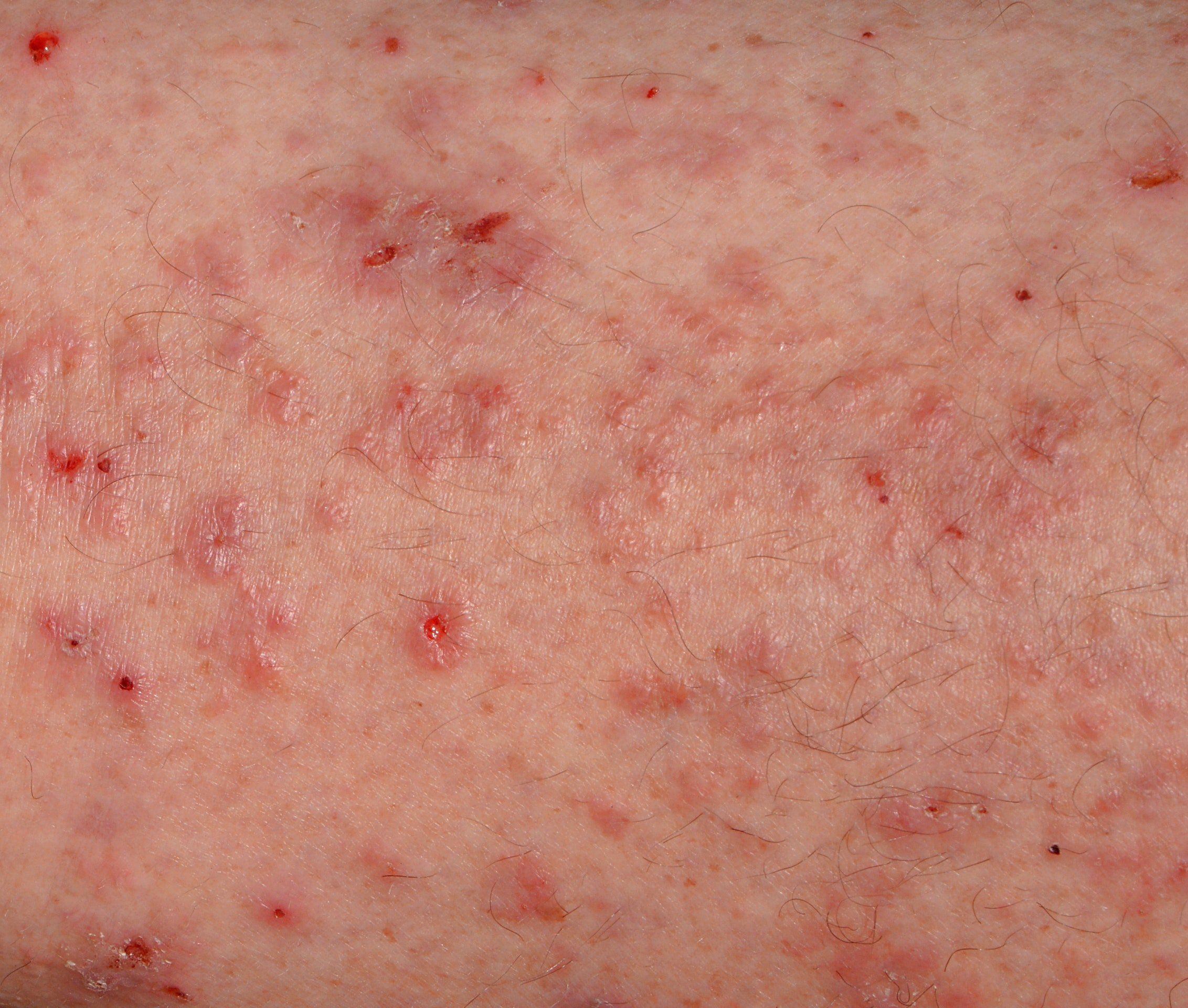 Itchy bleeding rash around anus