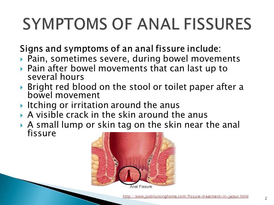 best of Treat Anal fissure