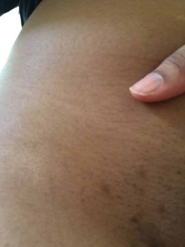 Dark spots on vagina