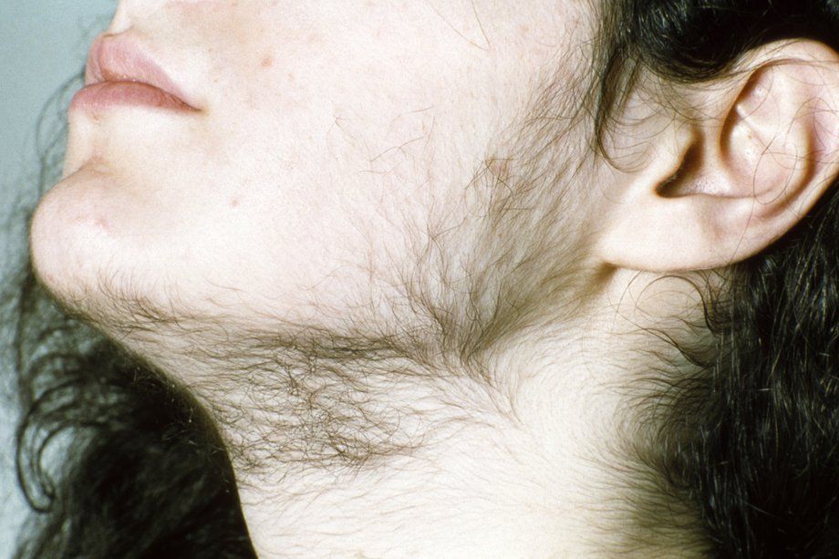 Rhubarb reccomend Increased facial hair growth in women