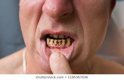 Ugly buck teeth girl