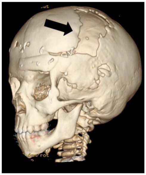 Sapphire reccomend Cranio facial skeleton