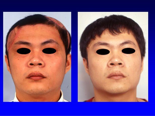 Microsurgical facial reconstruction