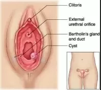 Sebaceous cyst of the vulva