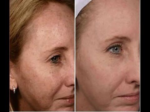 The T. reccomend Brown facial spots
