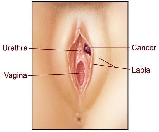 Thumbprint reccomend Bump under skin of vagina