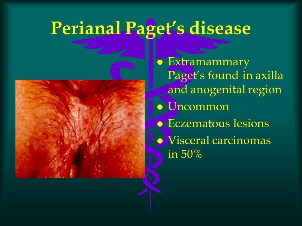 Pagets disease of anus