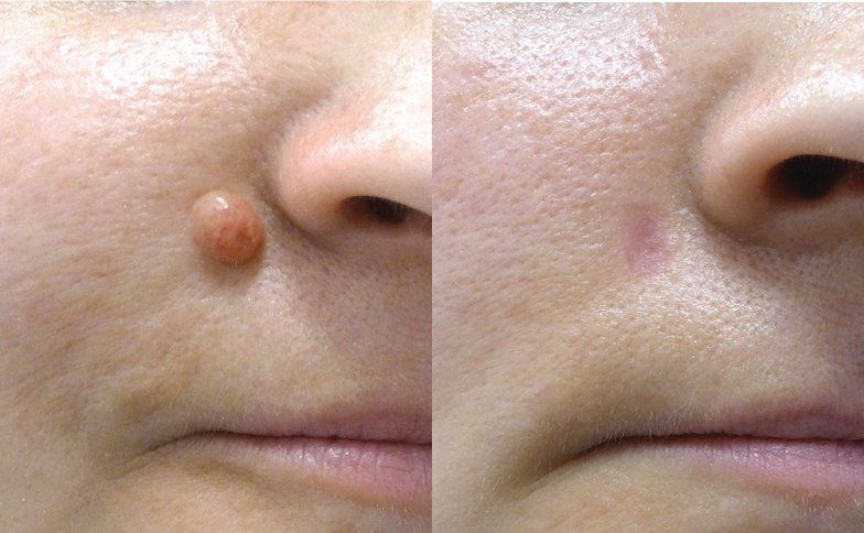 best of Removals Facial mole