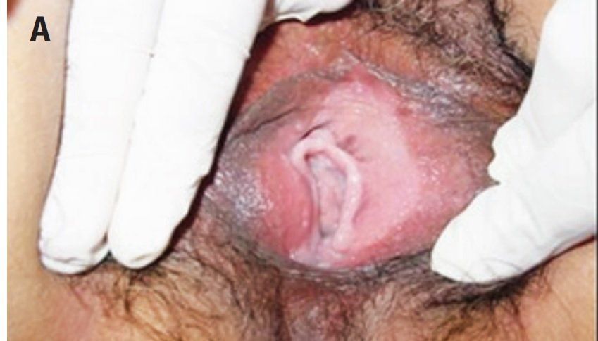 Sebaceous cyst of the vulva