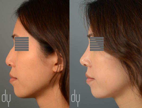 best of Before after nose job Asian