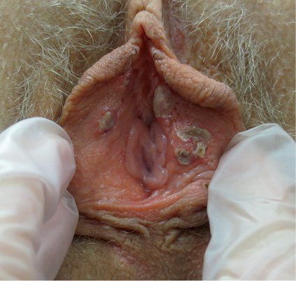 Ulcer on vulva