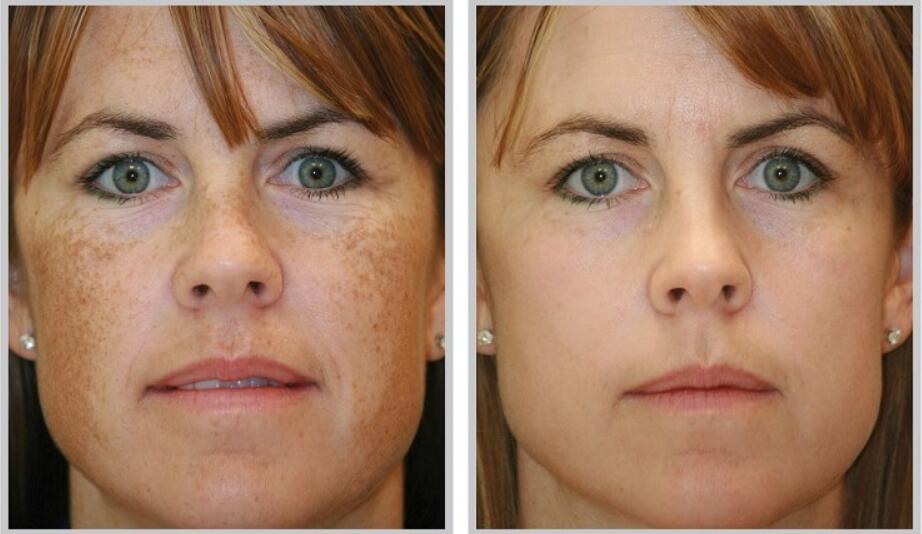 The E. Q. reccomend Brown facial spots