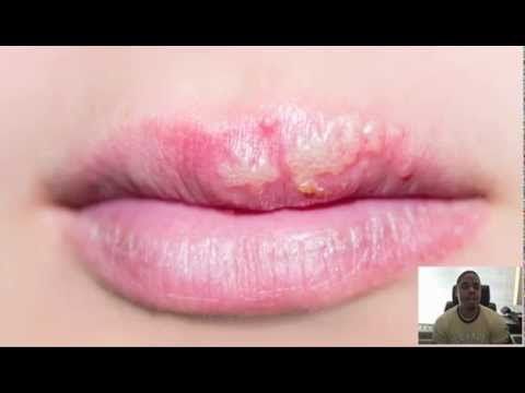 Can oral sex spread herpes