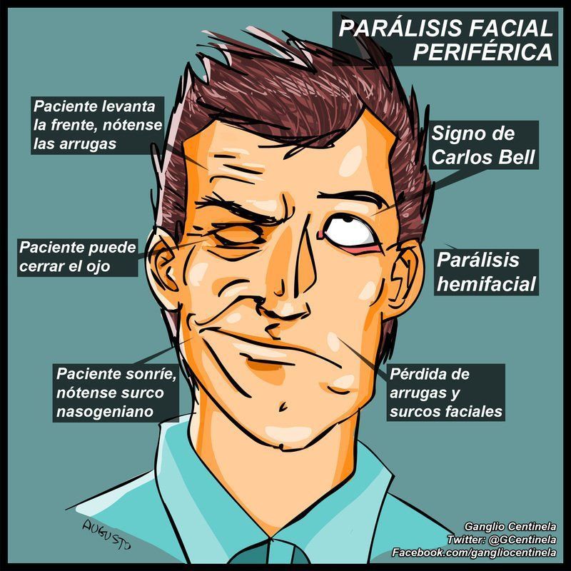 best of Estres Casa paralisis del facial