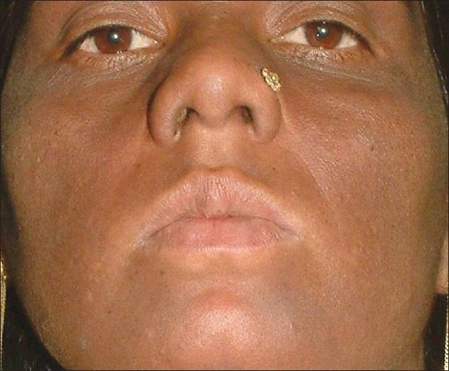Zodiac reccomend Causes of melasma facial swelling