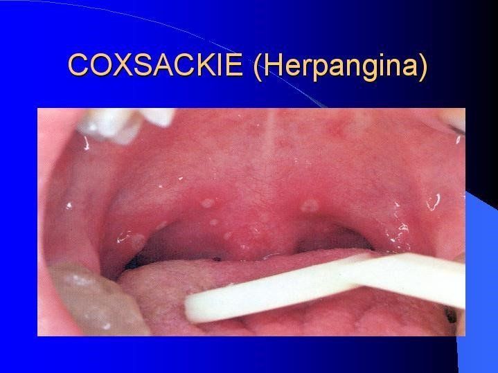 Parallax reccomend Coxsackie mouth