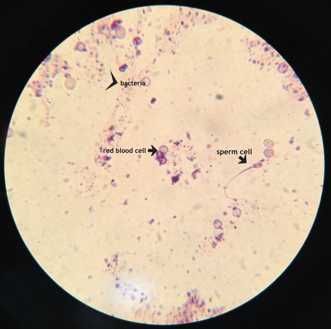 Sperm in urine microscope