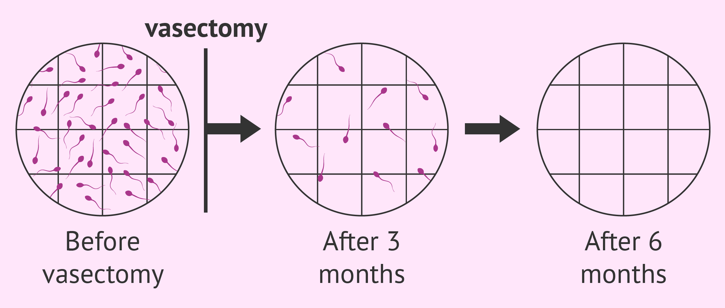 best of Sperm Post production vasectomy