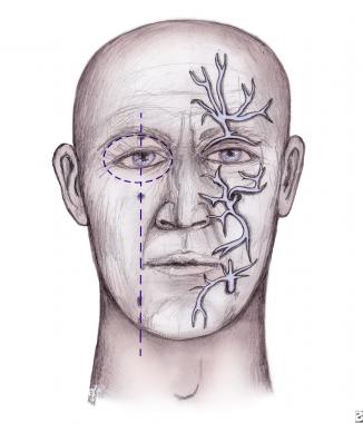 Facial lacerations repair emedicine