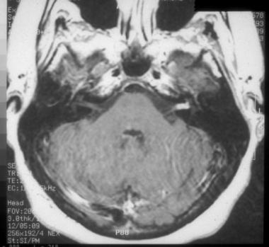 Facial schwannomas cranial nerve schwannoma