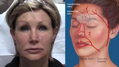 Duchess reccomend Microsurgical facial reconstruction