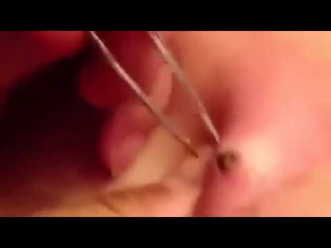 Painful cyst by my clitoris