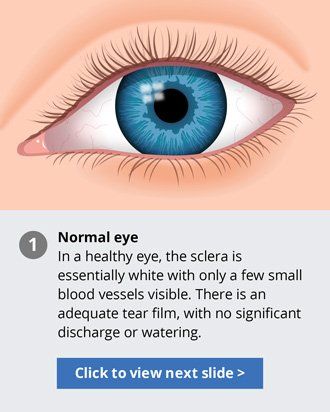 Pink eye in adult