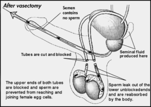 best of Sperm Post production vasectomy