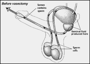 Pixy reccomend Post vasectomy sperm production