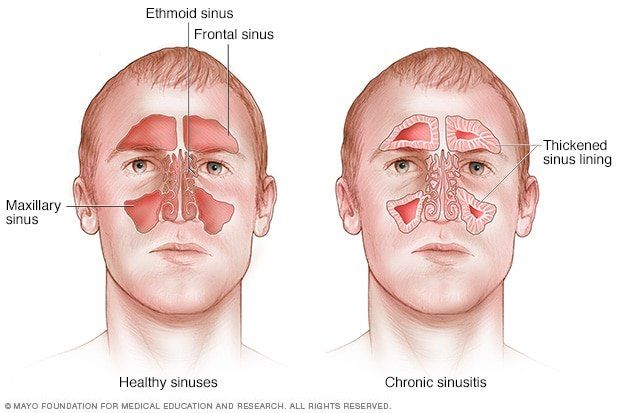 best of Paralysis facial infection Sinus causing
