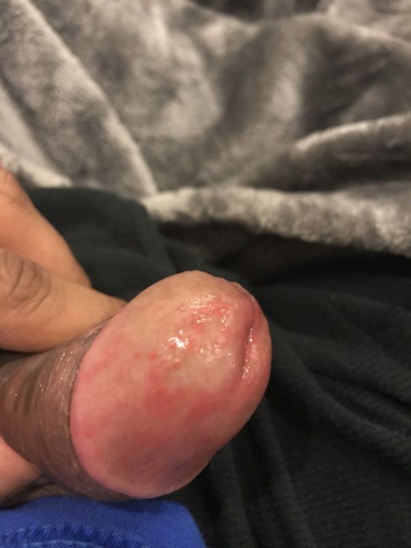 Spots on penis from masturbation