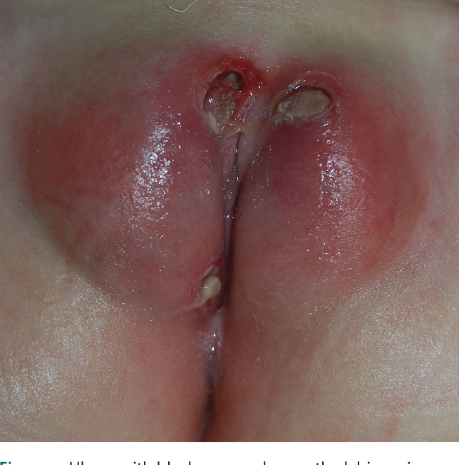best of Vulva Ulcer on